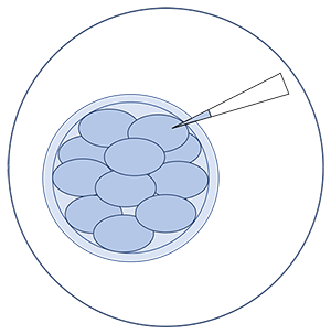 Преимплантационное генетическое тестирование анеуплоидий (PGT-А) эмбрионов методом NGS